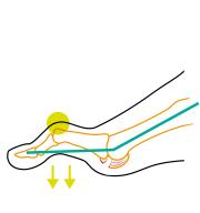 Korrekciós zokni kineziológiai kalapácsujjra Compressana TAPE SOX