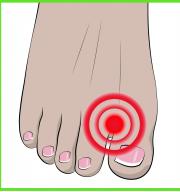 Ujjleválasztó védelem bütykökhöz (hallux valgus) 1 pár